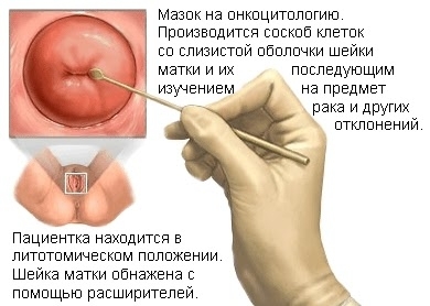 Как расшифровать цитологический анализ