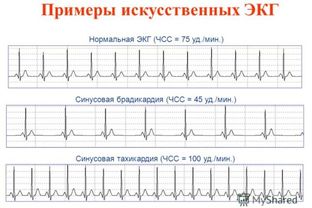 Как расшифровать экг сердца и диагностировать патологии сердца по экг