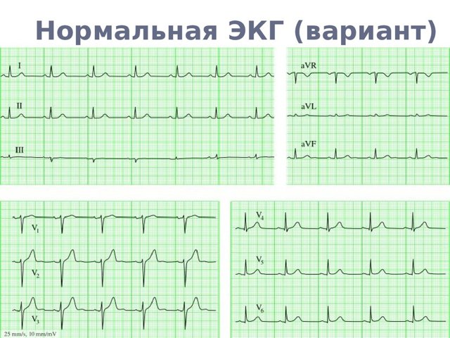 Как расшифровать экг сердца и диагностировать патологии сердца по экг