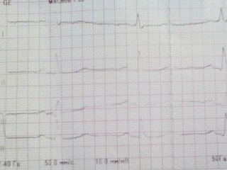Как расшифровать экг сердца и диагностировать патологии сердца по экг