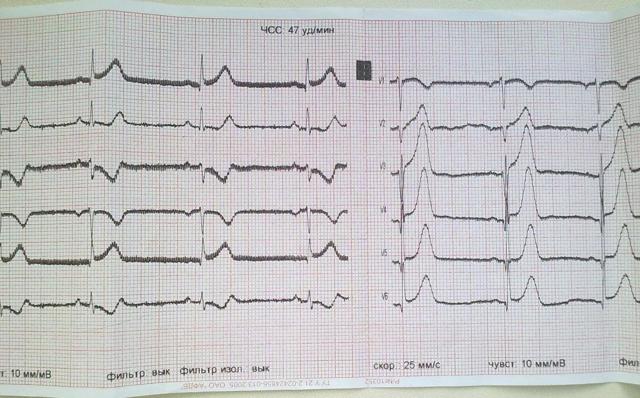 Как расшифровать экг сердца и диагностировать патологии сердца по экг