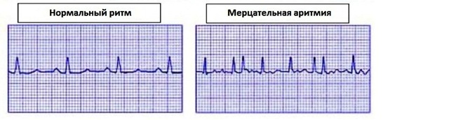 Как расшифровать экг сердца и диагностировать патологии сердца по экг