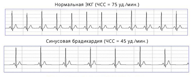 Как расшифровать экг сердца и диагностировать патологии сердца по экг