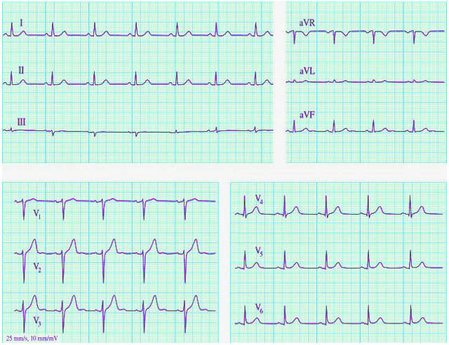 Как расшифровать экг сердца и диагностировать патологии сердца по экг