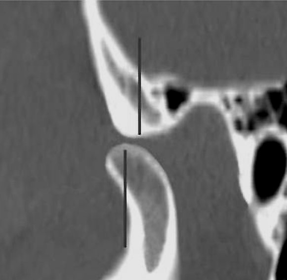 Как расшифровать мрт височно-нижнечелюстного сустава? | окейдок