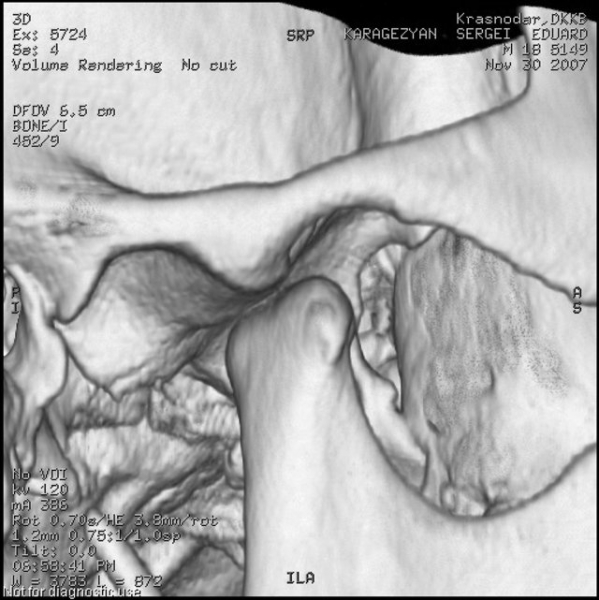 Как расшифровать мрт височно-нижнечелюстного сустава? | окейдок