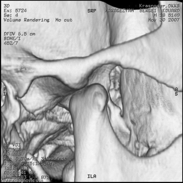 Как расшифровать мрт височно-нижнечелюстного сустава? | окейдок