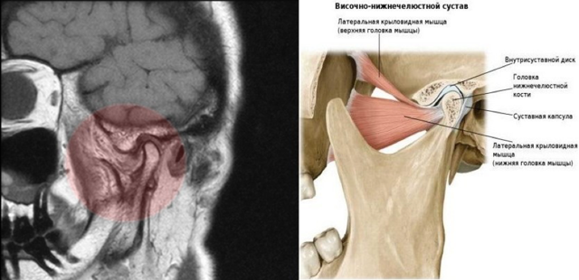 Как расшифровать мрт височно-нижнечелюстного сустава? | окейдок