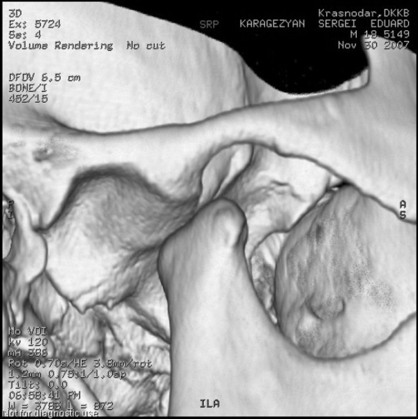 Как расшифровать мрт височно-нижнечелюстного сустава? | окейдок