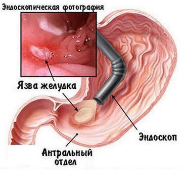 Как расшифровать результат флюорографии?