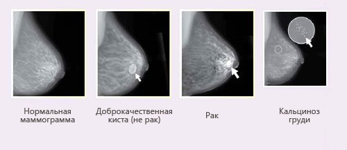 Как расшифровать результат маммографии