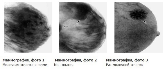 Как расшифровать результат маммографии