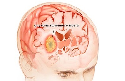 Как расшифровать результаты мрт: накопление контраста в области таламуса