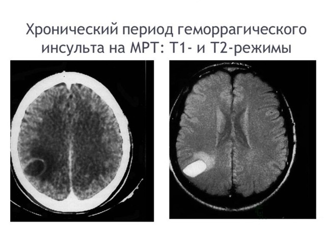 Как расшифровать результаты мрт: накопление контраста в области таламуса