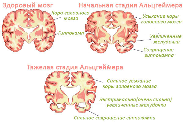 Как расшифровать результаты мрт: накопление контраста в области таламуса