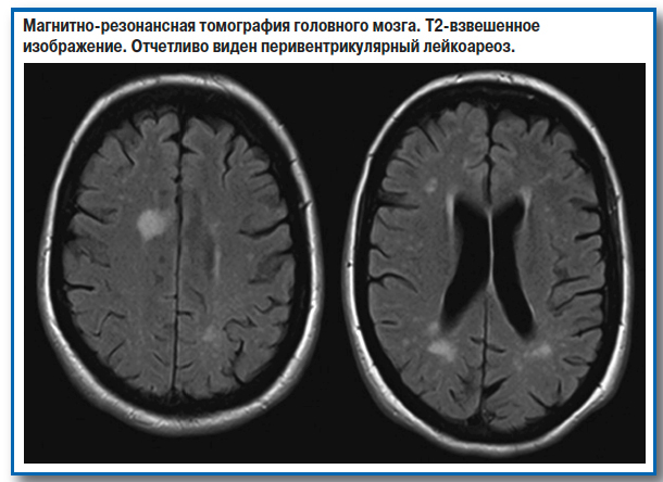 Как расшифровать результаты мрт: накопление контраста в области таламуса