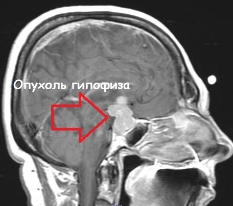 Как расшифровать результаты мрт: накопление контраста в области таламуса