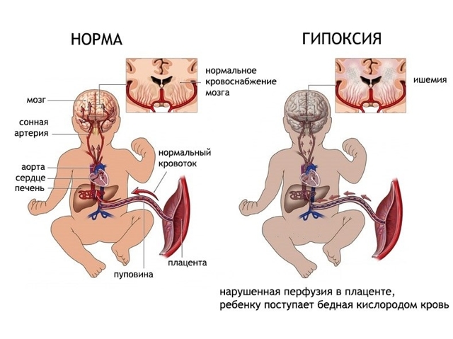 Как расшифровать результаты нейросонографии ребенка?