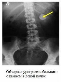 Как расшифровать результаты узи почек и экскреторной  урографии