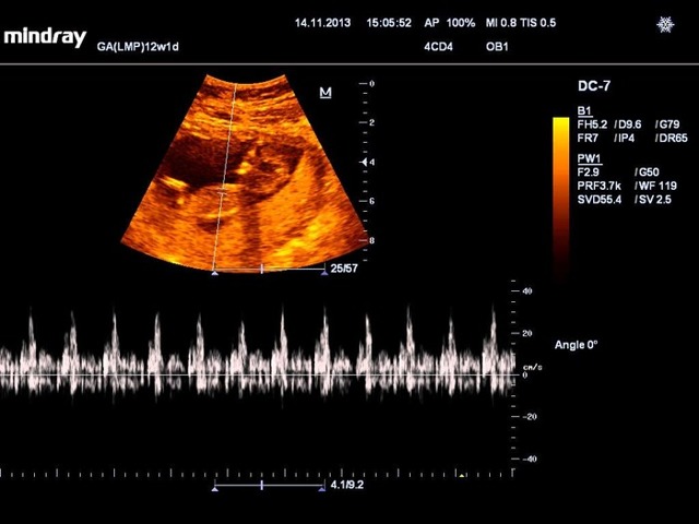Как расшифровать узи при беременности на ранних сроках 