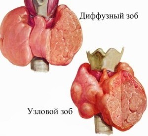 Как расшифровать узи щитовидки при подозрении на диффузный зоб: какие нормы объема щитовидной железы?