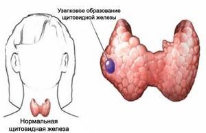 Как расшифровать узи щитовидки при подозрении на диффузный зоб: какие нормы объема щитовидной железы?