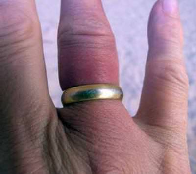 Как снять кольцо с опухшего пальца самостоятельно дома, причины отека