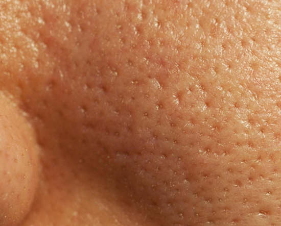 Как сузить расширенные поры на лице