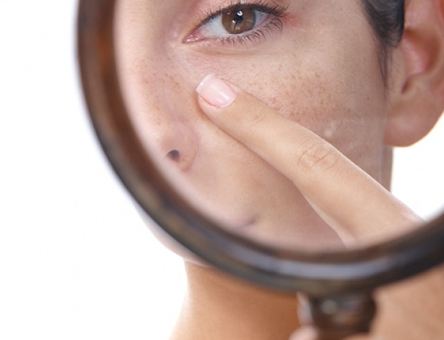 Как сузить расширенные поры на лице