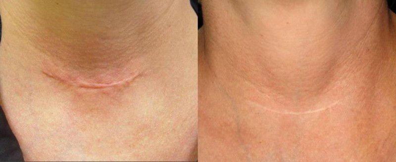 Как убрать шрамы, удаление рубцов