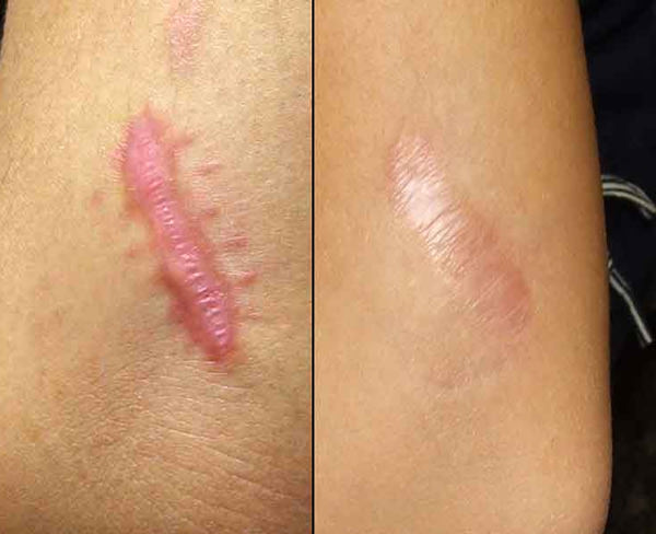 Как убрать шрамы, удаление рубцов