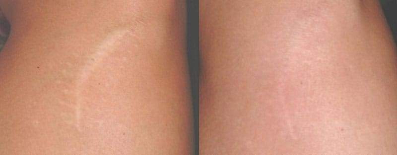 Как убрать шрамы, удаление рубцов