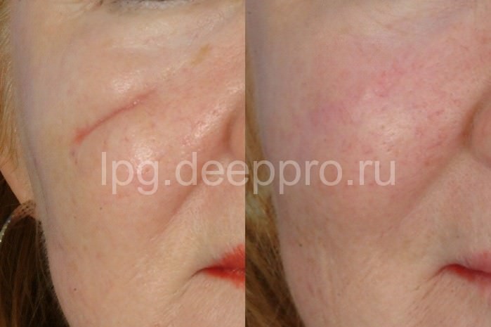 Как убрать шрамы, удаление рубцов