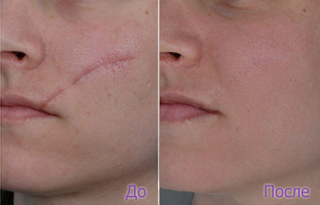 Как убрать шрамы, удаление рубцов