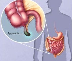 Как узнать – аппендицит или нет, если болит живот и спина