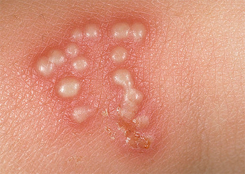 Как вылечить герпес, лечение в домашних условиях герпеса