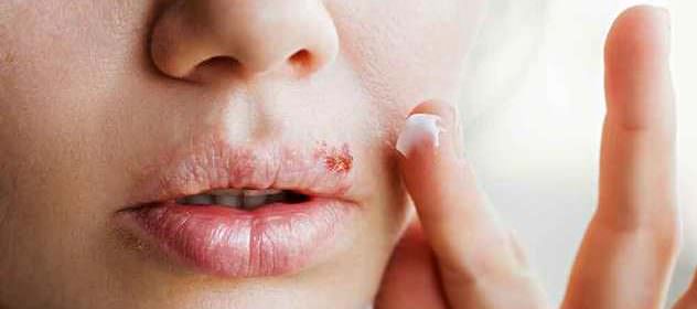Как вылечить герпес, лечение в домашних условиях герпеса