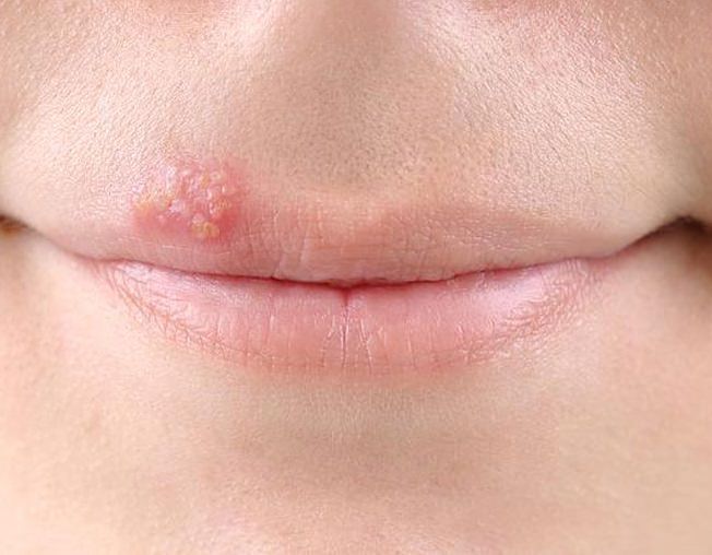 Как вылечить герпес, лечение в домашних условиях герпеса