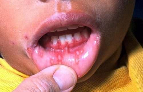 Как вылечить герпес, лечение в домашних условиях герпеса