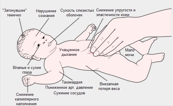 Как вылечить обезвоживание организма: способы восстановления организма после обезвоживания