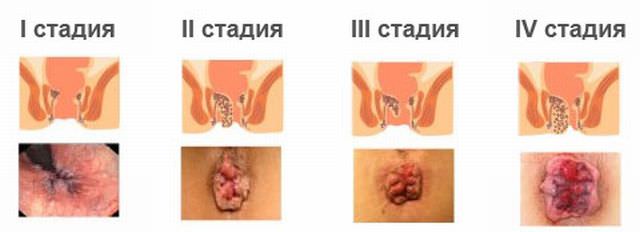 Как вылечить все стадии геморроя