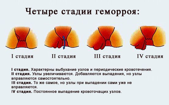 Как вылечить все стадии геморроя