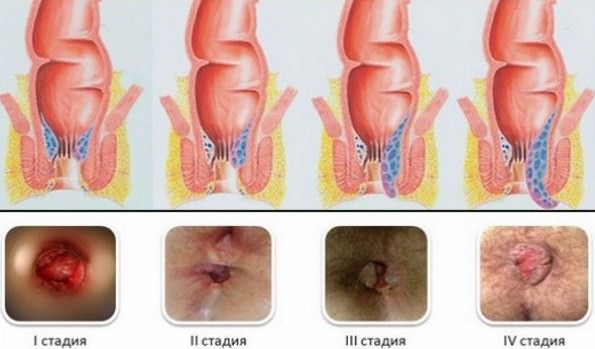 Как вылечить все стадии геморроя