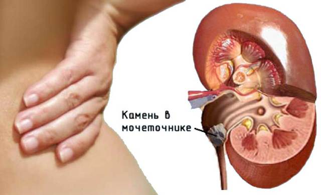 Как вывести песок из почек: лечебная и профилактическая чистка, подготовка к очищению, необходимые средства