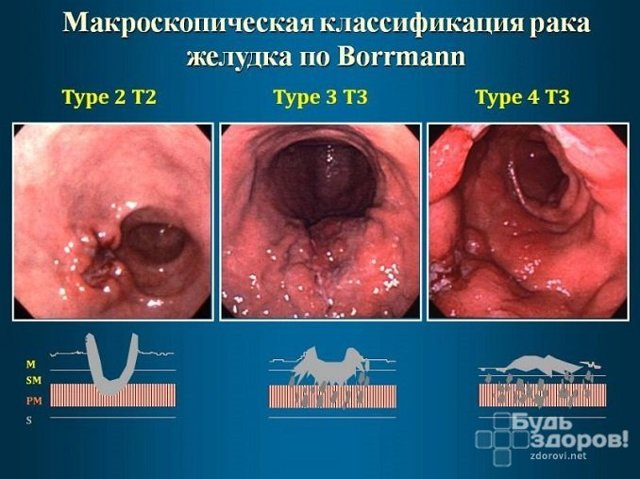 Какие анализы на онкомаркеры бывают