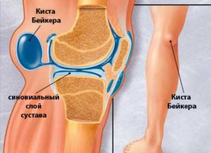Киста бейкера коленного сустава