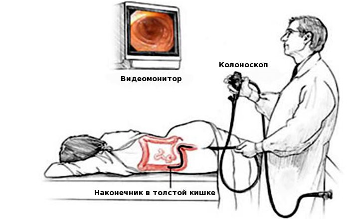 Колоноскопия: описание и подготовка