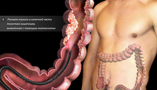 Колоноскопия: описание и подготовка