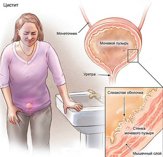 Лечение цистита в домашних условиях