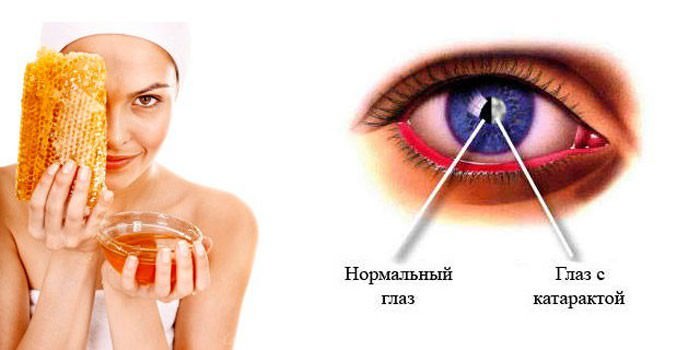 Лечение катаракты народными средствами